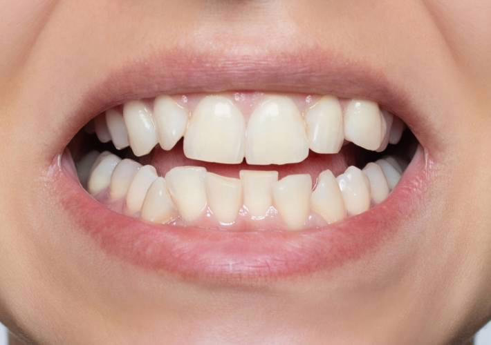 Dents de travers avant la pose de WellaSmile