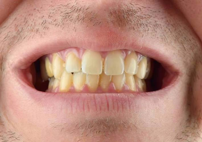 Dents jaunies recouvertes par un blanc uniforme WellaSmile