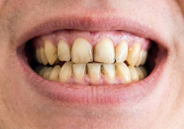 Taches dentaires couvertes par WellaSmile